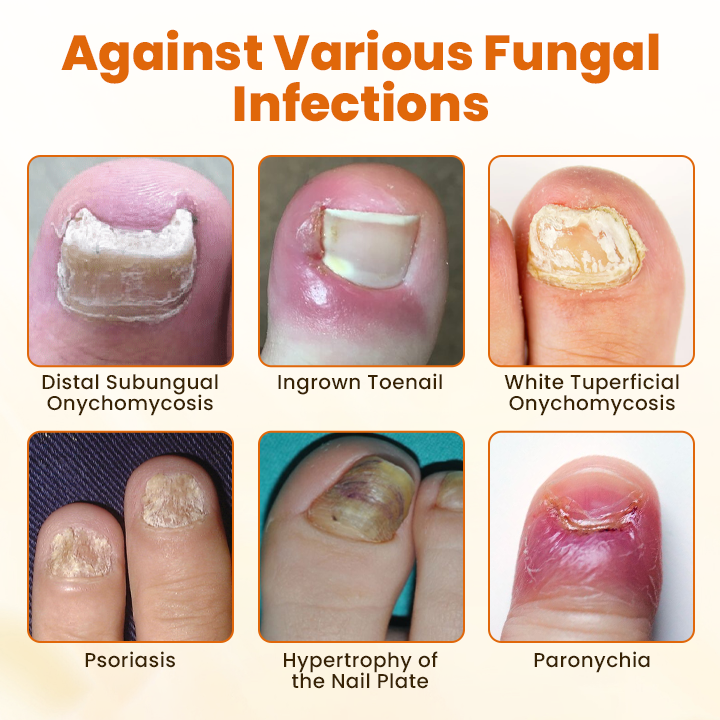 Timilk® FungiBee Advanced Nail Repair Spray.