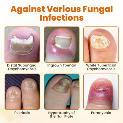 Timilk® FungiBee Advanced Nail Repair Spray.