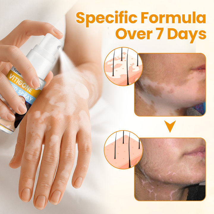 Timilk® VitiGone Rapid Spray — 2–3 Week Repigmentation with OTDS