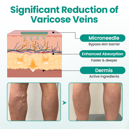 Timilk® LegRenew Varicose Veins Patch.