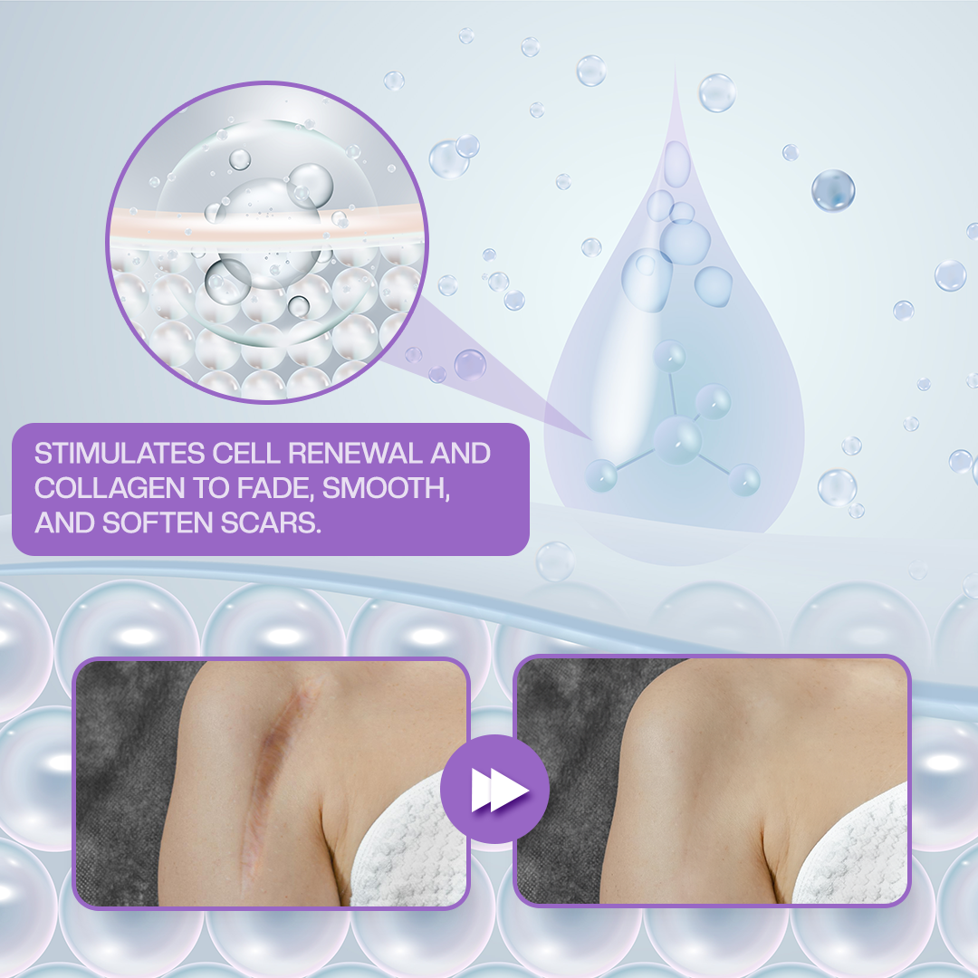 Timilk® RevivaDerma Face & Body Scar Gel - Clinically proven to soften, flatten and fade surgical scars, acne marks, burns, keloids and trauma-related scars