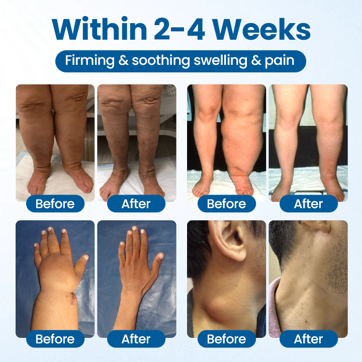 Timilk® Lymphora Swelling Relief Roll-On