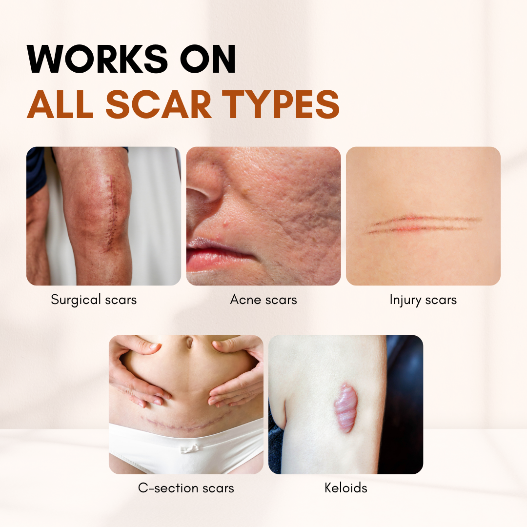 Timilk® ClearFlaw Silicone Scar Solution Stick