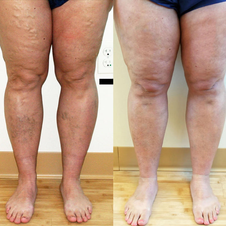 Timilk® Varicose Veins Healing Cream.