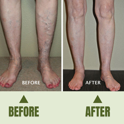 Timilk® Varicose Veins Healing Cream.