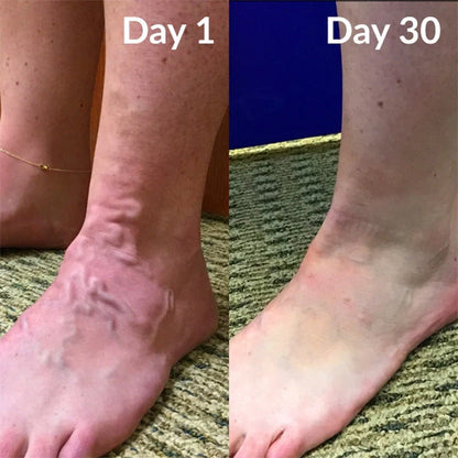 Timilk® Varicose Veins Healing Cream.
